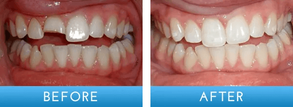 Before and after dental treatment at A Shop for Smiles