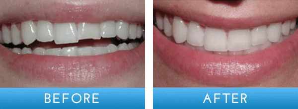 Before and after dental treatment at A Shop for Smiles