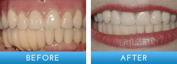 Before and after dental treatment at A Shop for Smiles