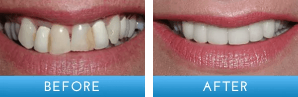 Before and after dental treatment at A Shop for Smiles