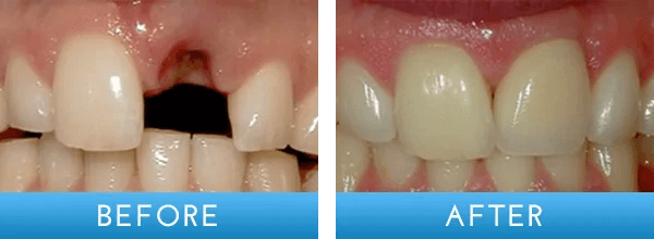 Before and after dental treatment at A Shop for Smiles