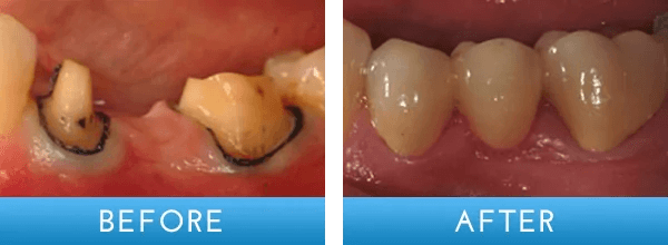 Before and after dental treatment at A Shop for Smiles