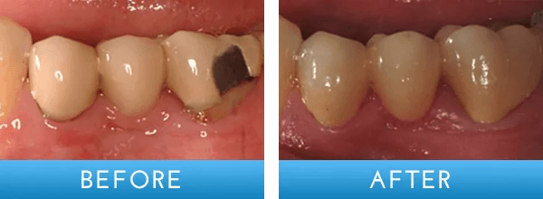 Before and after dental treatment at A Shop for Smiles