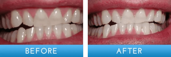 Before and after dental treatment at A Shop for Smiles